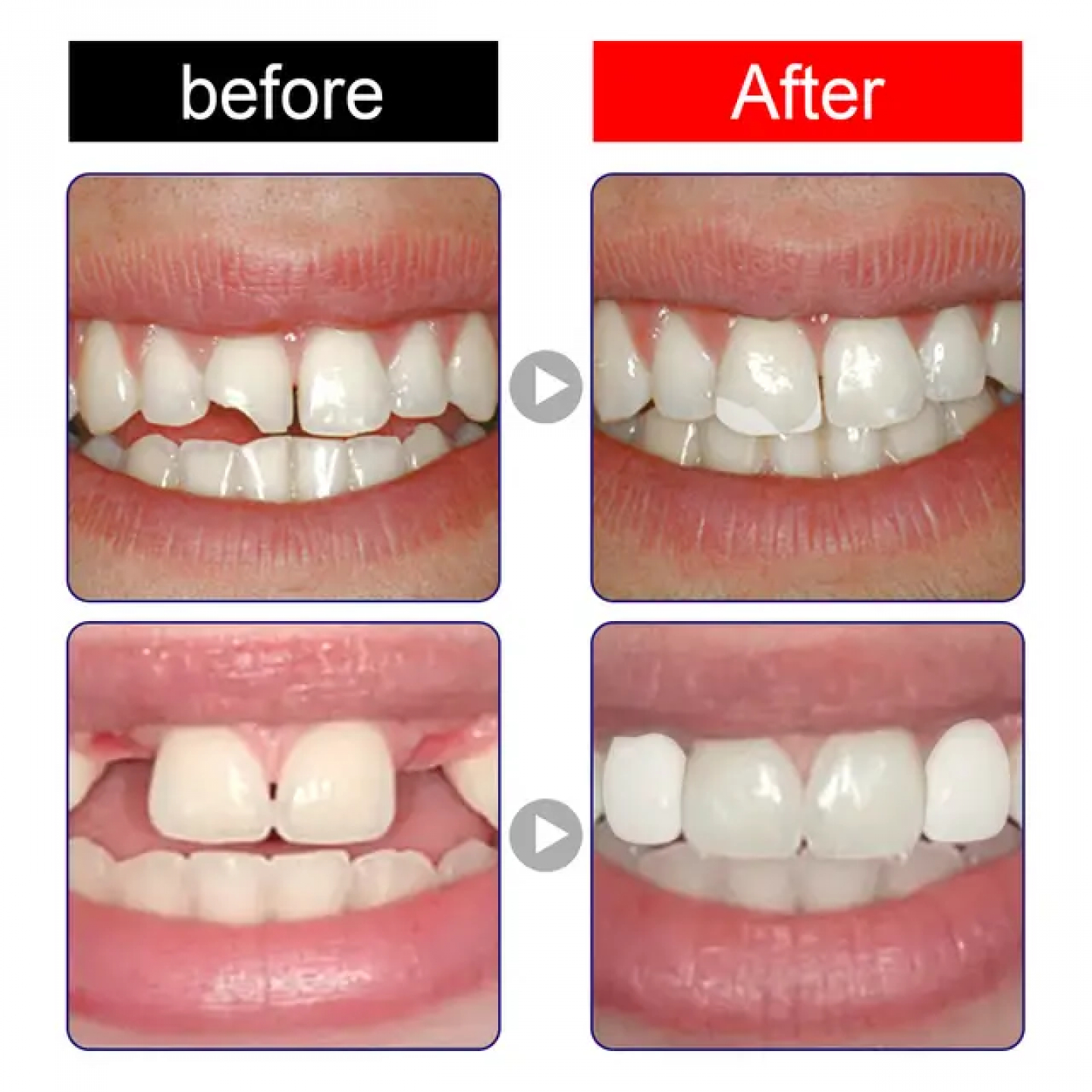 Remplacez le vide de vos dentés et même les dents cassées