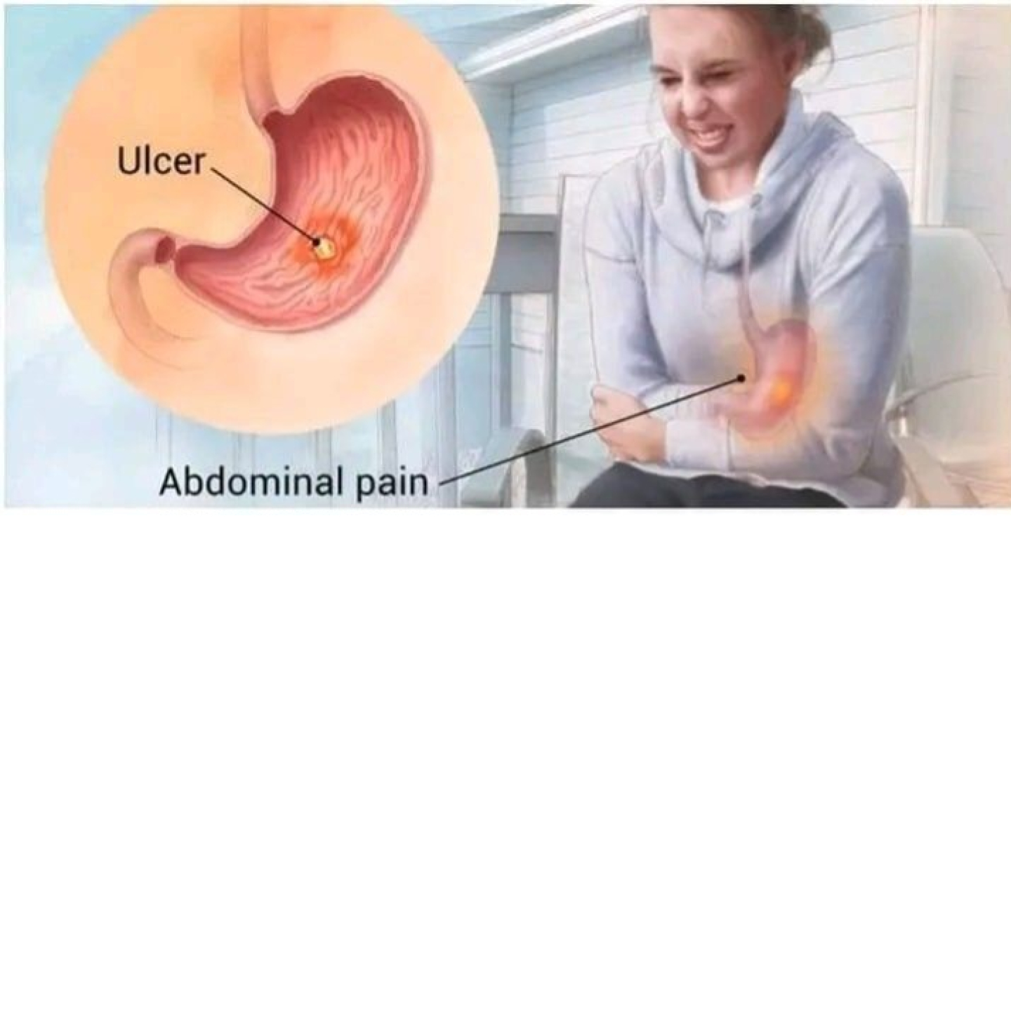 Ulcer de l'estomac 